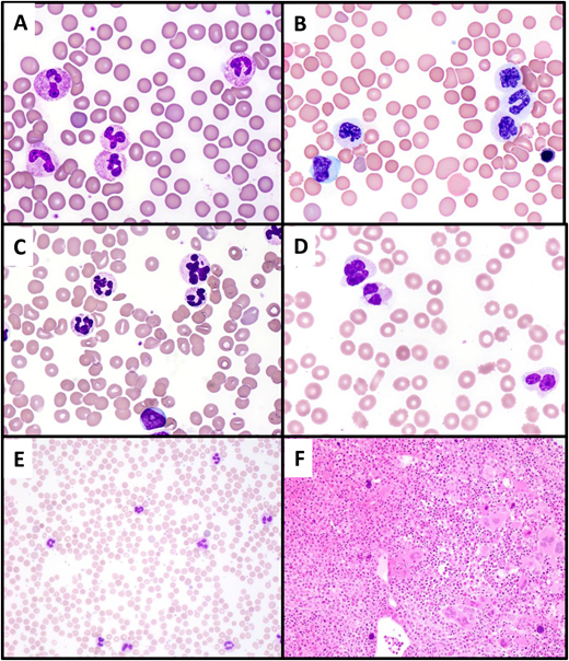 Differential diagnosis of CNL. (A) Paraneoplastic neutrophilia associated with plasma cell myeloma. A 65-year-old man with recurrent plasma cell myeloma presented with marked leukocytosis (WBC, 55 × 109/L; 88% neutrophils). The peripheral blood smear shows normal neutrophil morphology, and NGS studies showed no pathogenic mutations. (B, C) Atypical chronic myeloid leukemia. A 74-year-old man presented with leukocytosis (WBC, 60 × 109/L; 73% neutrophils, 5% metamyelocytes, 5% metamyelocytes, 2% blasts). The peripheral smear shows striking dysgranulopoiesis, with nuclear hyposegmentation and nonlobation (B) or hypersegmentation (C), as well as hypogranulation of neutrophils. A circulating blast is present (lower center of image C). (D) MDS with mutated TP53/MDS with biallelic TP53 inactivation presenting with neutrophilia due to concurrent infection. A 70-year-old man presented with anemia (Hb, 8.5 g/dL) and leukocytosis (WBC, 25.4 × 109/L; 82% neutrophils). The peripheral smear shows markedly dysplastic neutrophils, with nuclear hyposegmentation and hypogranulation. The patient was found to have cellulitis; following treatment of the infection, the WBC normalized to 4.08 × 109/L. (E, F) Primary myelofibrosis (prefibrotic) with neutrophilia. A 49-year-old woman presented with leukocytosis (WBC, 39.6 × 109/L; 85% neutrophils) and thrombocytosis (platelet count, 1256 × 109/L). The peripheral blood smear (E) shows normally granulated neutrophils, without left shift, potentially simulating CNL. The bone marrow biopsy (F) is markedly hypercellular with a granulocytic predominance, also simulating CNL. However, the megakaryocytes are enlarged and hyperchromatic and exhibit prominent clustering, features that suggest a “classic” MPN rather than CNL. NGS showed a JAK2 V617F mutation and the absence of CSF3R mutation.