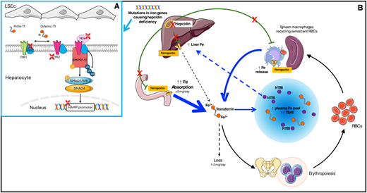 Pathophysiology of hemochromatosis. (A) Hepcidin production by hepatocytes is feedback-regulated by iron through complex multimolecular pathways. Interaction between BMPs (especially BMP2 and BMP6) produced by liver sinusoidal endothelial cells (LSEC) and BMP receptors 1-2 is the main pathway controlling basal hepcidin production. Hemojuvelin is a BMP coreceptor. High Fe (HFE) and transferrin receptor 2 (TFR2) participate in iron sensing and modulate the response to increased circulating iron. For a comprehensive review, see Galy et al.9 Mutations in heterogenous genes (red X) lead to hepcidin deficiency (B). Iron hyperabsorption and excess iron release from macrophages expand the plasma iron pool (blue arrows) with the formation of toxic non-transferrin-bound iron (NTBI), which accumulates in the liver and other organs. Fe, iron; RBC, red blood cell.