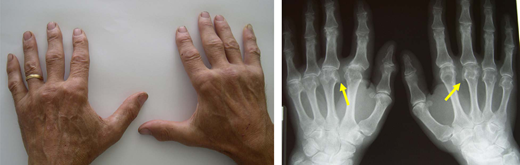 Hemochromatosis arthropathy. Typical bilateral involvement of the metacarpophalangeal joints, especially the second and third, with plain radiogram showing the classical “hook” osteophytes. Hemochromatosis arthropathy can involve multiple other joints, including the hip, ankle, knee, elbow, shoulder, and spine.