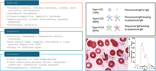 Diagnostic and therapeutic approach to cryoglobulinemia. The peripheral blood smear shows cryoglobulin precipitates mimicking platelets as well as altered erythrocyte morphology due to cryoglobulin attached to the red cell surface. Herishanu Y; Katz B-Z; ASH image bank 60686. CG, cryoglobulin.