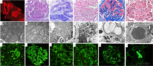 Pathology of MGRS lesions with organized Ig deposits. (a-c): AL amyloidosis: review of Congo red stain under the Texas red immunofluorescence filter reveals bright red smudgy deposits in glomeruli, vessels, and focally in the interstitium (a, × 100). The deposits on transmission EM are composed of randomly oriented straight fibrils (b, × 40 000). On immunofluorescence, smudgy amyloid deposits in glomeruli and interstitium stain positive for lambda light chain (c, × 200) but not for kappa light chain (not shown). (d-f): Immunotactoid glomerulopathy. The glomerulus exhibits global mesangial and endocapillary hypercellularity with intracapillary infiltrating lymphocytes and monocytes (d, PAS, × 400). The deposits on EM are composed of microtubular structures with parallel alignment (e, × 40 000). On immunofluorescence, there is bright granular to semilinear glomerular positivity for IgG (f, × 400) and kappa light chain but not for lambda light chain (not shown). (g-i): Light chain proximal tubulopathy. Numerous osmophilic crystals with needle and rod shapes are seen within proximal tubular cells (g, toluidine blue–stained EM survey section, × 400). EM reveals the engorgement of proximal tubular cells by rhomboidal and rod-shaped crystals, causing compression of the nuclear contours (h, × 4400). Immunofluorescence on paraffin tissue after antigen retrieval with pronase reveals staining of proximal tubular cells for kappa light chain (i, × 400) but not for lambda light chain (not shown). (j-l): Light chain CSH. There is interstitial infiltration of histiocytes containing intracytoplasmic red crystalline inclusions (j, trichrome stain, × 400). A high-power EM image shows rhomboidal and rod-shaped intralysosomal crystals in an interstitial histiocyte (k, × 8000). Immunofluorescence on paraffin tissue after antigen retrieval with pronase reveals staining of crystals within interstitial histiocytes for kappa light chain (l, ×400) but not for lambda light chain (not shown). (m-o): Light chain crystalline podocytopathy. Podocytes are filled with trichrome-red crystalline inclusions. There is partial collapse of the underlying glomerular tuft (m, trichrome stain, × 600). High-power EM image shows highly electron dense crystals within podocytes (n, × 8000). Many rod-shaped and rhomboidal inclusions within podocytes stain positive for kappa light chain by immunofluorescence on paraffin tissue after antigen retrieval with pronase (o, × 400) but not for lambda light chain (not shown). (p-r): Crystalglobulin-induced nephropathy. Many eosinophilic, needle-shaped crystals are present within glomerular capillaries, associated with a macrophage-rich inflammatory reaction and mild mesangiolysis (p, hematoxylin and eosin, × 600). Large highly electron-dense extracellular crystals are seen plugging the glomerular capillaries. Similar but fewer crystals are also seen in the subendothelial region and mesangium (q, EM, × 8000). Large crystals in vessels stain brightly for IgG by immunofluorescence on paraffin tissue after antigen retrieval with pronase (r, × 400) and kappa light chain but not for lambda light chain (not shown).