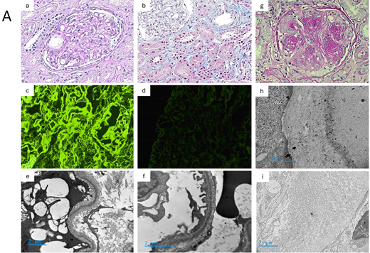 (A) Pathology of MGRS lesions with nonorganized deposits: MIDD. (a-f): Patient's kidney biopsy, light chain deposition disease. Glomeruli show mild mesangial sclerosis, with thickened capillary walls and Bowman's capsule membrane (a, PAS stain, × 400). Mildly thickened tubular basement membranes show Congo red negative deposits (not shown) (b, trichrome stain, × 400). On immunofluorescence, diffuse linear deposits of kappa light chains are seen in the mesangium, around capillary walls, and in the tubular basement membranes (c, × 400), whereas no staining is observed for lambda light chain (d, × 400). On EM, linear “powdery punctuate” deposits are visible on the outer aspect of tubular basement membranes (e, × 10 000) and on the inner aspect of glomerular basement membranes (f, × 15 000). LCDD: typical pattern of nodular glomerulosclerosis with aneurysmal dilatation of glomerular capillary loops (g, PAS stain, × 400). LCDD: EM showing linear glomerular deposits stained with a gold conjugated anti-kappa light chain antibody (h, × 30 000), without significant staining for lambda light chain (i, × 10 000).
