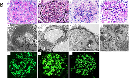 (B) Pathology of other MGRS lesions with nonorganized deposits and MGRS lesions without Ig deposits. (a-c): Proliferative glomerulonephritis with monoclonal immunoglobulin deposits. Glomeruli exhibit lobular accentuation due to prominent mesangial expansion by mesangial hypercellularity and sclerosis, with associated global duplication of the glomerular basement membranes and cellular interposition (a, PAS stain, × 400). On EM, large granular subendothelial nonorganized electron dense deposits (arrow) are seen (b, × 8000). On immunofluorescence, there is granular to semilinear global glomerular capillary wall and mesangial staining for IgG (c, ×400) and kappa light chain, with negative staining for lambda light chain (not shown). (d-f): C3 glomerulonephritis associated with monoclonal gammopathy. The glomerulus shows global mesangial expansion by an increase in mesangial cell number and the presence of glassy silver-negative immune deposits. There is segmental duplication of the glomerular basement membranes (arrows) (d, silver stain, × 400). On EM, large mesangial (large arrows) and small intramembranous (small arrow) electron dense deposits are evident (e, × 8000). On immunofluorescence, there is bright global granular mesangial and glomerular basement membrane staining for C3 (f, × 400). Glomeruli were negative for immunoglobulins and C1q (not shown). (g-i): Dense deposit disease associated with monoclonal gammopathy. The glomerulus exhibits global endocapillary hypercellularity with numerous intracapillary infiltrating neutrophils with some lymphocytes and monocytes (g, × 400). An EM image showing highly electron dense deposits occupying most of the thickness of the glomerular basement membrane (small arrows), with nodular deposits in the mesangium (large arrow) (h, × 6000). On immunofluorescence, there is bright global granular glomerular basement membrane and mesangial staining for C3 (i, × 400). Glomeruli were negative for immunoglobulins and C1q (not shown). (j-k): Glomerular microangiopathy associated with monoclonal gammopathy. The glomerulus exhibits segmental mesangiolysis (arrows) and duplication of the glomerular basement membrane (j, × 400). On EM images from a patient with POEMS syndrome shows global mesangiolysis and marked widening of the subendothelial zone by electron lucent fluffy material (k, × 4000). POEMS, polyneuropathy, organomegaly, endocrinopathy, monoclonal plasma cell disorder, skin changes.