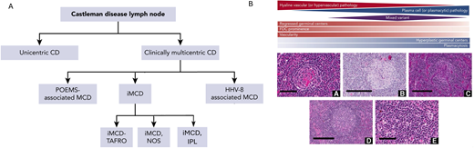 Clinical and histopathological spectrum of Castleman disease.1,3 A. Castleman disease (CD) is clinically divided based on LN distribution (multicentric vs unicentric) and etiology (HHV8-associated, POEMS-associated, and idiopathic). Idiopathic MCD (iMCD) is further subdivided based on clinical subtype (TAFRO, NOS, and IPL, which is a recently implicated subtype of NOS). B. CD subtypes are generally distributed across 3 histopathological subtypes: (1) hyaline/hypervascular, (2) plasmacytic, and (3) mixed.