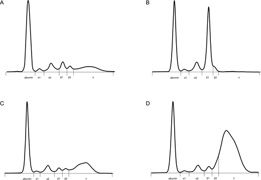 Serum protein electrophoresis tracings. (A) Normal; (B) a 40-g/L monoclonal band running in the β1 region in a patient with IgG4 myeloma; (C) PHGG, predominantly IgG1, in a patient with Sjӧgren syndrome; (D) PHGG with beta-gamma bridging in a patient with IgG4-RD (Clinical Case 1). Figure courtesy of Eric Zhao and Andre Mattman.