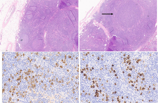 Excisional axillary lymph node biopsy from a patient with IgG4-RD with a PTGC pattern of IgG4-LAD. Hematoxylin and eosin (H&E) stain, top left and right 2 images at 4 × magnification. Top left: The lymph node shows follicular hyperplasia with progressive transformation of germinal centers. Top right: There is a notable absence of obliterative phlebitis and capsular and storiform fibrosis. Bottom left: IgG stain. Bottom right: IgG4 stain. Hot spots show more than 100 IgG4-positive cells per high-powered field, and the IgG4 to IgG ratio is higher than 40%. Figure courtesy of Collin Pryma.