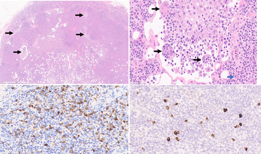 RDD LAD with increased IgG4+ plasma cells. Top left: H&E, 2 × magnification. Left axillary lymph node biopsy from a patient with RDD disease. The lymph node architecture is preserved, but there are distended sinuses with lesional histiocytes (top left image, arrows). Top right: H&E, 40 × magnification. Histiocytes with ample eosinophilic cytoplasm and nuclei containing prominent nucleoli characterize the lesion. Many contain engulfed inflammatory cells (emperipolesis), such as those labeled with a black arrow. Occasional background plasma cells are identified (blue arrow). Bottom left: IgG immunohistochemical stain, 40 × magnification. The higher magnification of Figure 4 highlights the many plasma cells positive for IgG. Bottom right: IgG4 immunohistochemical stain, 40 × magnification. The higher magnification of Figure 4 highlights the scattered plasma cells positive for IgG4. The IgG4/IgG ratio is not increased (14%). Figure courtesy of Collin Pryma.