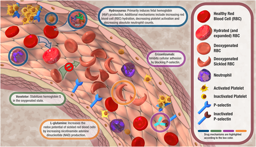 Proposed mechanisms of action of hydroxyurea, L-glutamine, voxelotor, and crizanluzimab. Voxelotor was an approved therapy that was recently withdrawn from the market due to safety concerns.