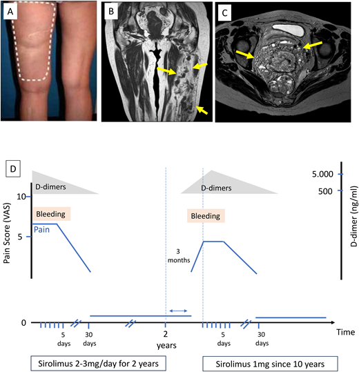 Clinical case. (A) Extensive bluish lesions on left lower limb; (B) magnetic resonance imaging showing extensive venous malformation in most of the muscles of the thigh (blue arrows); (C) magnetic resonance imaging showing involvement of the perineal area (blue arrows); (D) evolution of symptoms (bleeding and visual analogue score of the pain on sirolimus with rapid arrest of bleeding after sirolimus initiation and recurrence of symptoms after arrest of sirolimus. The reintroduction of sirolimus at a lower dose subsequently controlled the symptoms.
