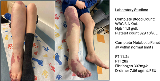 Patient clinical photographs and baseline laboratory studies. Photographs demonstrate a child with a capillary-venous- lymphatic malformation of the right lower extremity with overgrowth. Symptoms include pain, fatigue, and exercise intolerance. Laboratory studies were notable for an elevated D-dimer without any other hematologic abnormalities. Hgb, hemoglobin; PT, prothrombin time; PTT, partial prothrombin time; WBC, white blood cell count.
