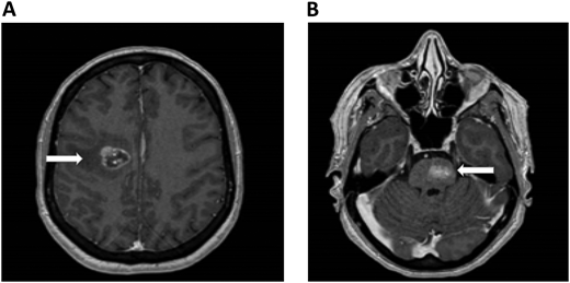Brain MRI in a patient with non–small cell lung cancer and brain metastases. An axial section of a T1 image with contrast shows right frontal metastases (Panel A) and brain stem metastases (Panel B). The white arrows denote these findings.