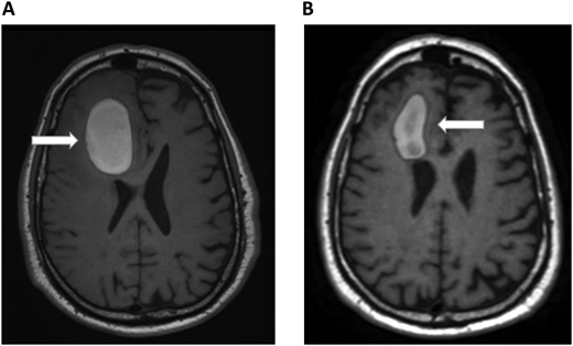 Brain MRI in a patient with melanoma and hemorrhagic brain metastases. In Panel A, an axial section of a T1 image without contrast shows a right frontal hemorrhage (5 cm × 3 cm) with mass effect. In Panel B, a T1 image with contrast demonstrates improvement in the right frontal hemorrhage (3.5 cm × 2 cm) and its mass effect. The white arrows denote these findings.
