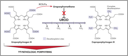 Inhibition of UROD by uroporphomethene leads to the accumulation of porphyrins and manifestations of disease in PCT. Under normal conditions, UROD converts uroporphyrinogen to coproporphyrinogen by a series of 4 sequential decarboxylations. In the presence of iron and free radicals, uroporphyrinogen is partially oxidized, leading to the formation of a uroporphomethene inhibitor of UROD. Decarboxylated uroporphyrinogen intermediates subsequently accumulate and auto-oxidize to their corresponding porphyrins, predominantly uroporphyrins. Photosensitive porphyrins accumulate in the plasma and are responsible for the cutaneous manifestations of PCT. Fe, iron; PCT, porphyria cutanea tarda; UROD, uroporphyrinogen decarboxylase; ROS, reactive oxygen species. Professional illustration by Patrick Lane, ScEYEnce Studios.