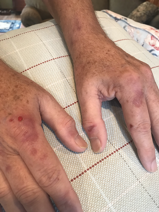 Scarring and blistering lesions on sun-exposed skin in a patient with porphyria cutanea tarda.