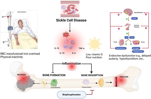 Contributing factors such as inflammation, low vitamin D, iron overload, delayed puberty, and bouts of inactivity in SCD result in decreased bone formation by osteoblasts and increased bone resorption by osteoclasts, leading to avascular necrosis, fractures, and pain. Osteoclast mediated resorption can be limited by bisphosphonates. FSH, follicle-stimulating hormone; GnRH, gonadotropin hormone-releasing hormone; IL, interleukin; LH, luteinizing hormone; ROS, reactive oxygen species. Created with Biorender.com