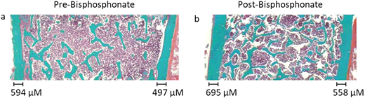 Improvement in bone architecture as well as cortical wall thickness as seen in an individual treated with bisphosphonates for 2 years. © 2022 by Grimbly et al9 and licensed under CC BY-NC 4.0. To view a copy of this license, visit https://creativecommons.org/licenses/by-nc/4.0/.