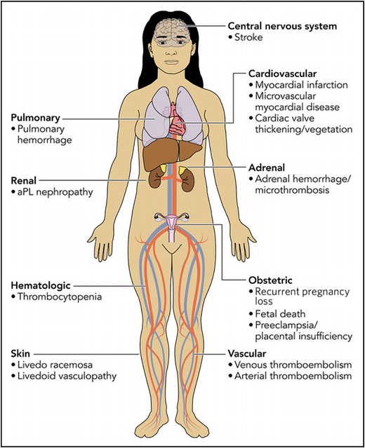 Clinical manifestations of antiphospholipid syndrome included in the ACR/EULAR classification criteria. For detailed definitions of the clinical criteria and documentation, readers are referred to Table 1 of the 2023 ACR/EULAR APS classification criteria document.