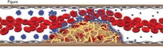 Nanoparticle Activity in a Thrombotic Site. Blood flowing left to right encounters vascular narrowing due to a thrombus. Shear-activated nanotherapeutics (blue aggregates) break up into nanoparticles (blue particles) due to high shear stress at the site of the thrombus.
