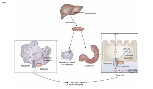 Role of Hepcidin in the Regulation of Intestinal Iron Absorption. Inflammation induces the synthesis of hepcidin by the liver, which then promotes the internalization and degradation of ferroportin, a transmembrane iron exporter, impairing the export of iron from macrophages and duodenal enterocytes. This process leads to decreased serum iron and, with time, an iron-restricted anemia. Thus, induced expression of hepcidin is a key mechanism of the anemia of inflammation.Figure adapted and redrawn from: Diagnosis and management of iron deficiency anemia in patients with IBD. Jürgen Stein, Franz Hartmann & Axel U. Dignass. Nature Reviews Gastroenterology & Hepatology 7, 599-610 (November 2010). doi:10.1038/nrgastro.2010.151