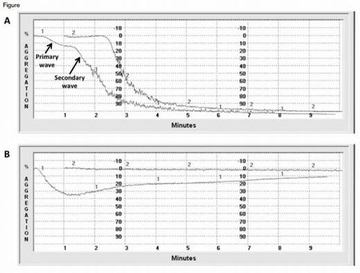 Representative Normal and Abnormal LTA Tracings. Figure A shows normal responses to epinephrine 1.0 μM (curve 1) and collagen 2.0 mg/mL (curve 2). At critical concentrations, weak agonists such as epinephrine and ADP induce a biphasic response. The primary wave of aggregation reflects response to the addition of exogenous agonist. When normal platelets are activated, they secrete an endogenous pool of agonists. The secondary wave represents aggregation in response to this endogenous pool. Figure B is a tracing from a patient with epistaxis and menorrhagia. The response to ADP 5.0 μM (curve 1) is attenuated. A primary wave of aggregation is followed by deaggregation and an absent secondary wave of aggregation. There is no response to epinephrine 5.0 μM (curve 2). The patient’s platelets also demonstrated abnormal ATP secretion in response to ADP and epinephrine. Electron microscopy of the patient’s platelets revealed an absence of dense granules consistent with a diagnosis of dense granule storage pool disorder.