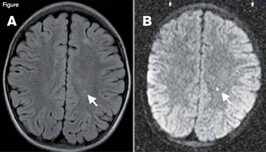 Silent Cerebral Infarction (SCI). A small stroke is visualized here in T2-weighted (panel A) and diffusion-weighted magnetic resonance images (panel B) in a patient with sickle cell disease. Given the restricted diffusion (panel B), this stroke was imaged in the acute phase (onset in the past 10 to 14 days). This patient with incidentally discovered acute silent cerebral ischemia was asymptomatic, had a normal neurologic examination, was in his baseline state (“steady-state”), and was undergoing a screening MRI for a clinical trial. The motor strip was not affected by this stroke, so it is classified as “silent” (an SCI), but a stroke is a stroke, and the brain is more than a motor strip.