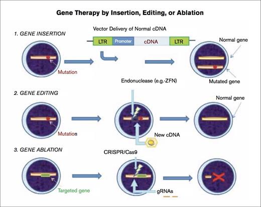 Gene Therapy by Insertion, Editing, or Ablation.1) Gene insertion – The mutation is depicted by the red spot. A vector (e.g., self-inactivating gammaretroviral or lentiviral vector) is used to introduce the normal cDNA encoding the entire protein into the cell under regulation by an appropriate promoter, and this vector integrates into the host cell genomic DNA. Transcription then proceeds, and the normal protein is produced. Both the mutated gene and the normal gene are present in the cell. 2) Gene editing – The affected cell shows the location of the mutation leading to the disorder with a red spot. A zinc finger nuclease (ZFN) is introduced, and cells are transduced with a vector, in this case, an integrase deficient lentiviral vector (IDLV) containing the normal partial cDNA for the affected gene, resulting in high-fidelity homology directed repair (HDR) and, thereby, correction of the defect. 3) Gene ablation – The CRISPR (clustered, regularly interspaced, palindromic repeats) –associated protein 9 (Cas9) nuclease is introduced in combination with short guide RNAs (gRNAs) that target the nuclease to the gene of interest (represented in green), resulting in cleavage of specific DNA sequence. Certain pairs of gRNAs successfully abrogate gene expression (depicted by red X).