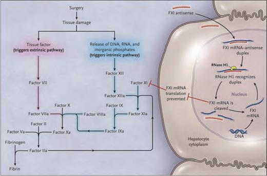 Effect of FXI-ASO on the Coagulation System. FXI-ASO (ISIS 416858) Is a Factor XI (FXI)–targeted Second-generation Antisense Oligonucleotide. Tissue damage after surgery exposes tissue factor and results in the release of DNA, RNA, and inorganic polyphosphate from damaged cells and from activated platelets and neutrophils. Tissue factor binds factor VIIa and initiates the extrinsic pathway of coagulation, whereas DNA, RNA, and polyphosphate activate factor XII and initiate the intrinsic pathway of coagulation. FXI–targeted antisense oligonucleotide attenuates the intrinsic pathway by binding to factor XI messenger RNA (mRNA) in the liver, which results in ribonuclease H1 (RNase H1) –mediated degradation of FXI messenger RNA, thereby preventing protein synthesis and reducing circulating FXI levels.From The New England Journal of Medicine, Harry R. Büller, Claudette Bethune, Sanjay Bhanot, et al, Factor XI Antisense Oligonucleotide for Prevention of Venous Thrombosis, Volume 372, Page 233 Copyright © 2015 Massachusetts Medical Society. Reprinted with permission from Massachusetts Medical Society.