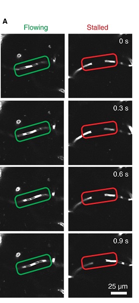 Sequential 2PEF Images That Demonstrate Flowing and Stalled Capillaries in the Cerebral Cortex (Images Captured Every .3 Seconds for a Total of 1.2 Seconds of Observation). Texas Red-dextran was intravenously injected to label blood plasma (bright), leaving the cellular components unlabeled (dark).Figure reprinted from Santisakultarm TP et al, J Thromb Haemost. 2014;12:2120-2130.