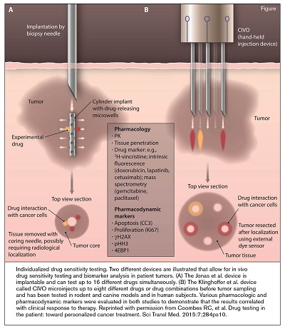 Individualized drug sensitivity testing. Two different devices are illustrated that allow for in vivo drug sensitivity testing and biomarker analysis in patient tumors. (A) The Jonas et al. device is implantable and can test up to 16 different drugs simultaneously. (B) The Klinghoffer et al. device called CIVO microinjects up to eight different drugs or drug combinations before tumor sampling and has been tested in rodent and canine models and in human subjects. Various pharmacologic and pharmacodynamic markers were evaluated in both studies to demonstrate that the results correlated with clinical response to therapy. Reprinted with permission from Coombes RC, et al. Drug testing in the patient: toward personalized cancer treatment. Sci Transl Med. 2015:7;284ps10.