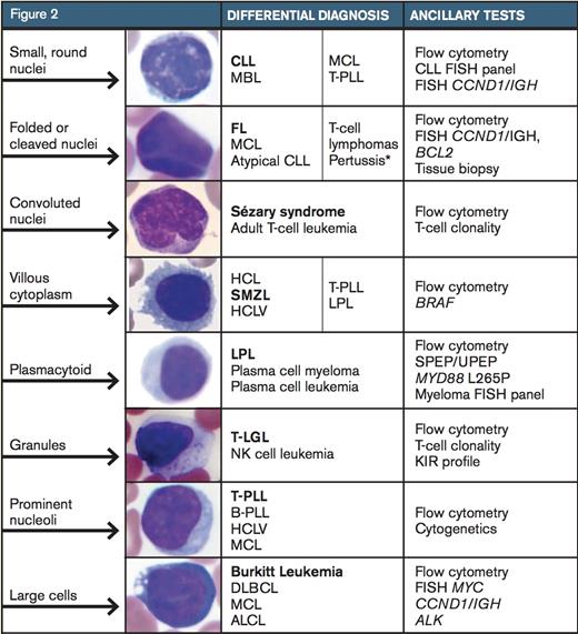 The differential diagnosis for a neoplastic lymphocytosis based on morphology in the peripheral blood smear. The bolded diagnosis represents the image shown. Further recommended ancillary testing is listed in the third column. CLL, chronic lymphocytic leukemia; MBL, monoclonal B-cell lymphocytosis; MCL, mantle cell lymphoma; T-PLL, T-prolymphocytic leukemia; FL, follicular lymphoma; HCL, hairy-cell leukemia; SMZL, splenic marginal-zone lymphoma; HCLV, hairycell leukemia variant; LPL, lymphoplasmacytic lymphoma, T-LGL, T large granular lymphocytic leukemia; B-PLL, B-prolymphocytic leukemia; DLBCL, diffuse large B-cell lymphoma; ALCL, anaplastic large-cell lymphoma. Adapted with permission from Chabot-Richards D, George TI. Leukocytosis. Int J Lab Hematol 2014;36:279-88, page 282, Figure 2. *Pertussis infection is a reactive cause of monomorphic lymphocytosis.