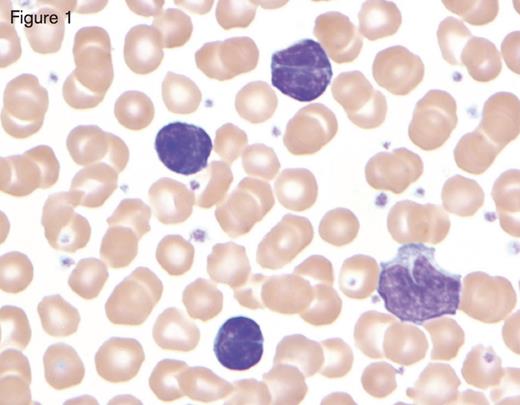 Bordetella pertussis infection in a child showing three reactive lymphocytes that are small with deeply cleaved nuclei and scant cytoplasm, in contrast with the monocyte in the lower right-hand corner. Reprinted with permission from I Pereira, TI George, DA Arber. Atlas of Peripheral Blood. The Primary Diagnostic Tool. Wolters Kluwer, Lippincott Williams and Wilkins, Inc., Philadelphia, PA (2012), page 130, Figure 13.5.