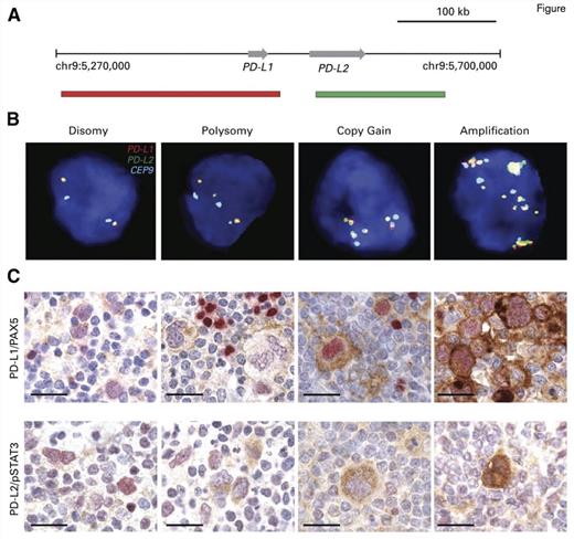 "Genetic and Immunohistochemical Analyses of the PD-L1 and PD-L2 Loci and PD-1 Ligand Expression. (A) Location and color labeling of the bacterial artificial chromosome (chr) clones on 9p24.1 used for fluorescent in situ hybridization (FISH). RP11-599H20 including PD-L1, labeled red. RP11-635N21 including PD-L2, labeled green. (B) Representative images of FISH results for the various categories. PD-L1 in red, PD-L2 in green, fused (F) signals in yellow, and centromeric probe in aqua (A). In these images, disomy reflects 2A:2F; polysomy, 3A:3F; copy gain, 3A:6F; and amplification, 15+F. (C) The top panel shows PD-L1 (brown)/PAX5 (red) immunohistochemistry (IHC) in the classical Hodgkin lymphoma cases with 9p24.1 disomy, polysomy, copy gain, and amplification from (B). The bottom panel shows PD-L2 (brown)/pSTAT3 (red) IHC in the same cHL cases. Scale bar = 50 μm.