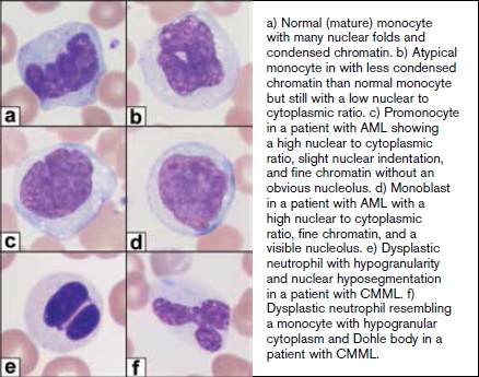 a) Normal (mature) monocyte with many nuclear folds and condensed chromatin. b) Atypical monocyte with less condensed chromatin than normal monocyte but still with a low nuclear to cytoplasmic ratio. c) Promonocyte in a patient with AML showing a high nuclear to cytoplasmic ratio, slight nuclear indentation, and fine chromatin without an obvious nucleolus. d) Monoblast in a patient with AML with a high nuclear to cytoplasmic ratio, fine chromatin, and a visible nucleolus. e) Dysplastic neutrophil with hypogranularity and nuclear hyposegmentation in a patient with CMML. f) Dysplastic neutrophil resembling a monocyte with hypogranular cytoplasm and Döhle body in a patient with CMML.