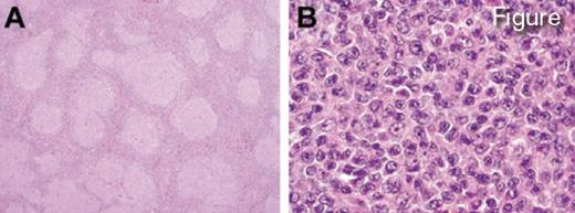 Morphologic Features of PTNFL at Low (40x) and High Power (400x) View. Reprinted with permission from Louissaint A Jr et al. Blood. 2012;120:2395-2404.