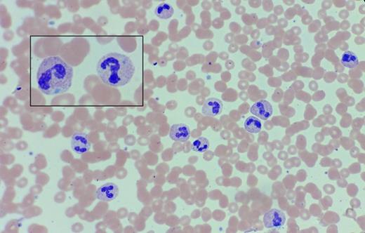 Peripheral Blood Smear. Peripheral blood smear in a 68-year-old woman with a history of chronic leukocytosis.