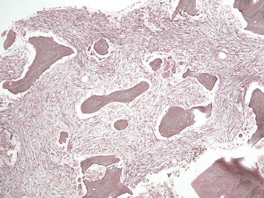 Reticulin Stain. Reticulin stain in a 29-year-old man with a history of recurrent necrotizing pancreatitis and end-stage renal disease.