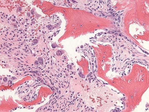 Hematoxylin and Eosin Stain. Hematoxylin and eosin stain in a 29-year-old man with a history of recurrent necrotizing pancreatitis and end-stage renal disease.