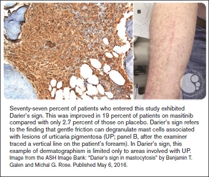 "Seventy-seven percent of patients who entered this study exhibited Darier’s sign. This was improved in 19 percent of patients on masitinib