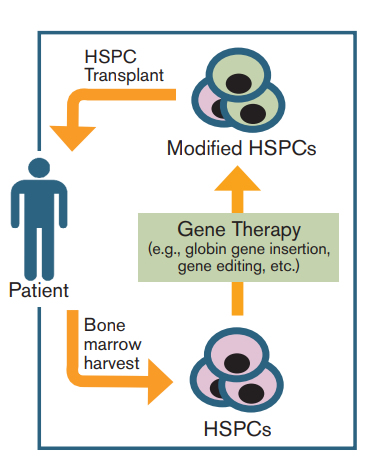 Diagram of the Typical Process of Gene Therapy for Hematopoietic Disorders. Hematopoietic stem and progenitor cells (HSPCs) can be modified directly, as is the case for currently used therapies. The genetically modified HSPCs are then transplanted back into the patient. When HSPCs are modified directly, modification may not occur in every cell. Goodman MA et al, Ther Adv Hematol. 15(5):302-315, copyright © 2016 by SAGE Publications. Reprinted by Permission of SAGE.