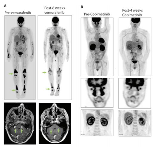 Examples of Responses of BRAF V600E and MAP2K1 Mutant Adults with Erdheim-Chester Disease (ECD) to Molecularly Targeted Therapies. A) Positron emission tomography (PET) scan and brain MRI of a BRAF V600E-mutant ECD patient with skeletal and parenchymal brain lesions pre- and eight-weeks post-treatment with the BRAF inhibitor vemurafenib. B) PET scan of a MAP2K1 Q56P-mutant ECD patient with disease infiltration in facial sinuses, heart, and kidneys pre- and four-weeks post-treatment with the MEK 1/2 inhibitor cobimetinib.