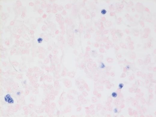 Hematoxylin and Eosin Stain Showing a Few Scattered Epstein-Barr Virus+ Cells. FHematoxylin and eosin stain showing a few scattered Epstein-Barr virus (EBV)+ cells.