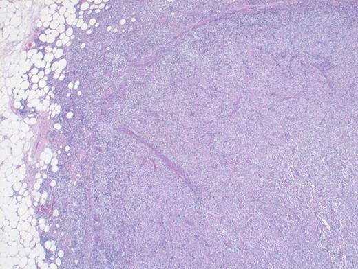 Hematoxylin and Eosin Stain Depicting Architectural Effacement by this Proliferation of Medium Sized Mononuclear Cells.