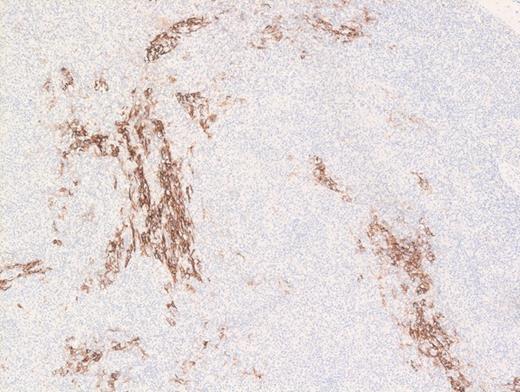 Hematoxylin and Eosin Stain Showing Wisps of Follicular Dendritic Cell Meshworks. Hematoxylin and eosin stain showing wisps of follicular dendritic cell meshworks.
