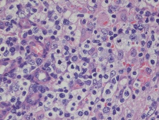 Hematoxylin and Eosin Stain Showing Architectural Effacement by a Proliferation of Medium-sized Mononuclear Cells. Alternate view of hematoxylin and eosin stain depicting architectural effacement by this proliferation of medium sized mononuclear cells.