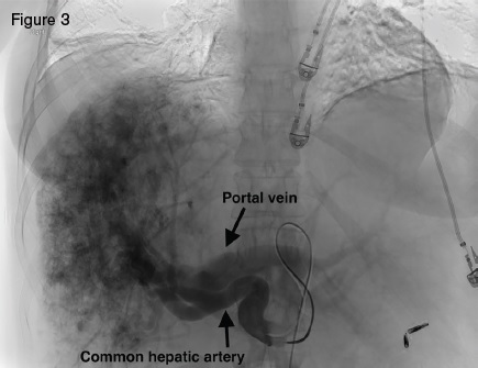 Angiogram displaying large hepatic arteries with shunting primarily from hepatic artery to portal vein.