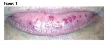 Mucocutaneous telangiectasias on the inner lower lip of a patient with hereditary hemorrhagic telangiectasia.