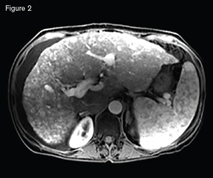 Magnetic resonance image showing a macronodular liver with diffuse arteriovenous malformations s involving both hepatic lobes, ascites, and splenomegaly.