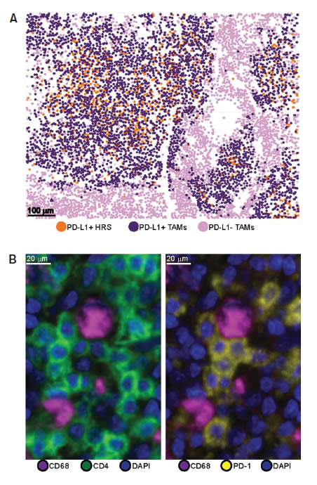 (A) Cellular phenotype map depicting locations of PD-L1+ Hodgkin Reed-Stemberg (HRS) cells (orange dots), PD-L1+ tumor-associated macrophages (TAMs) (purple dots), and PD-L1- TAMs (pink dots). (B) Representative image (40x resolution) showing CD4+ T cells (left panel, green) with coexpression of PD-1 (right panel, yellow) touching CD68+ TAMs (both panels, magenta). Adapted from Carey CD, et al. Blood. 2017;130:2420-2430.