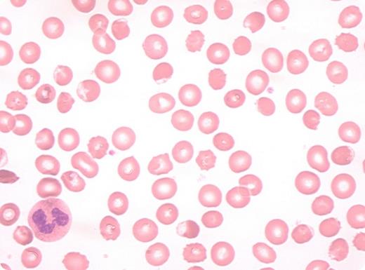 red cell film that shows a patient with a case of favism. / Red cell film from a patient with a case of favism.