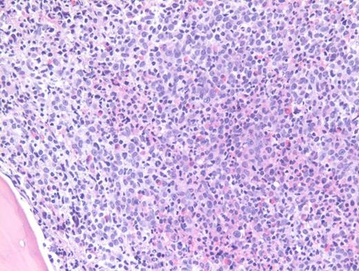 Hematoxylin and Eosin Stain of the Core Biopsy